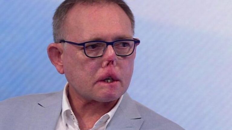 Doctor pierde ambas piernas por las lamidas de su perro